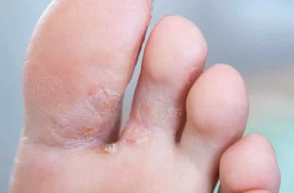 تصویر 3 از خرید و فروش پماد ترک پا با شرایط فوق العاده